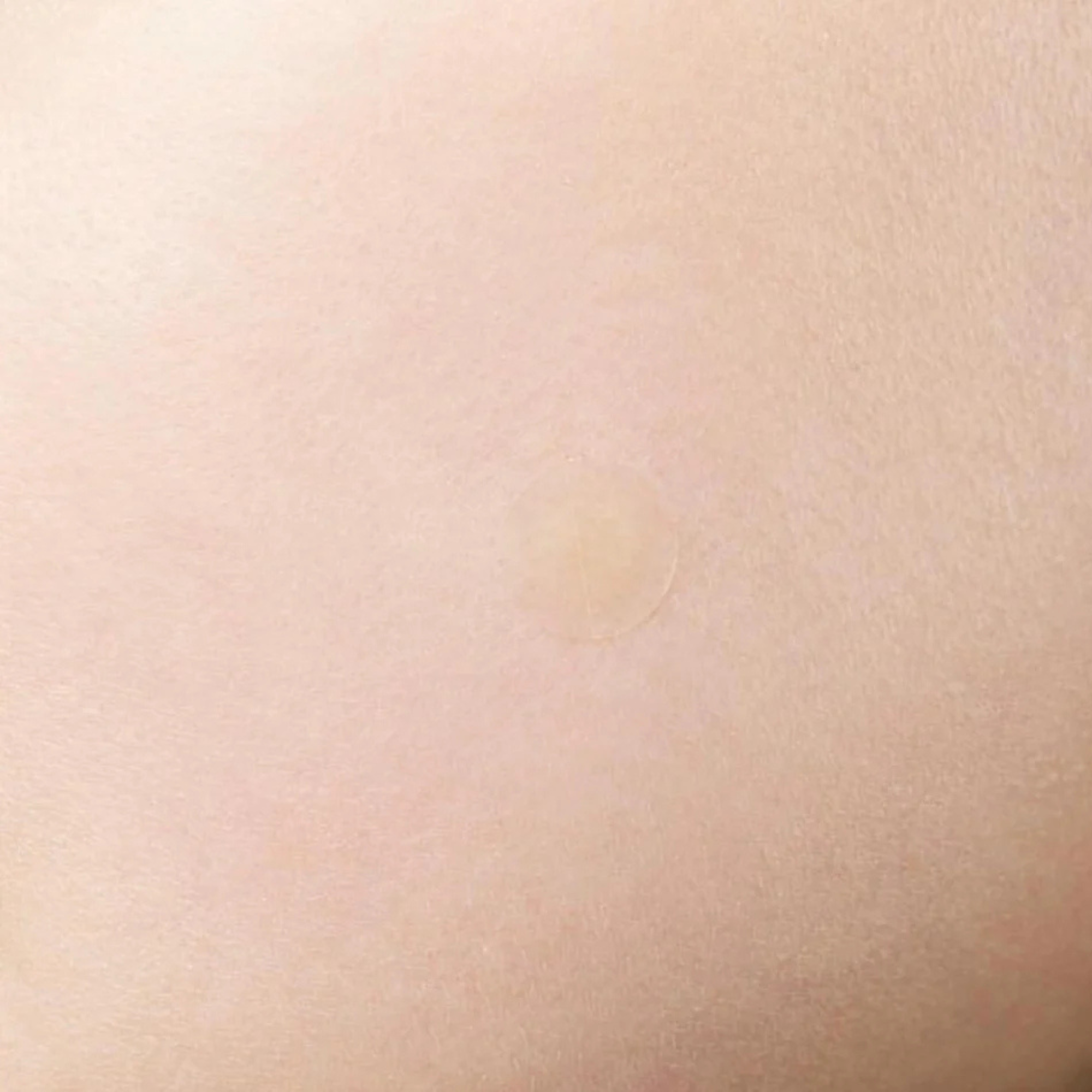 Acne Pimple Master Patch